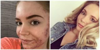 PŘED a&nbsp;PO: Žena se zbavila ošklivého akné! Stačilo jí k&nbsp;tomu udělat jednu věc