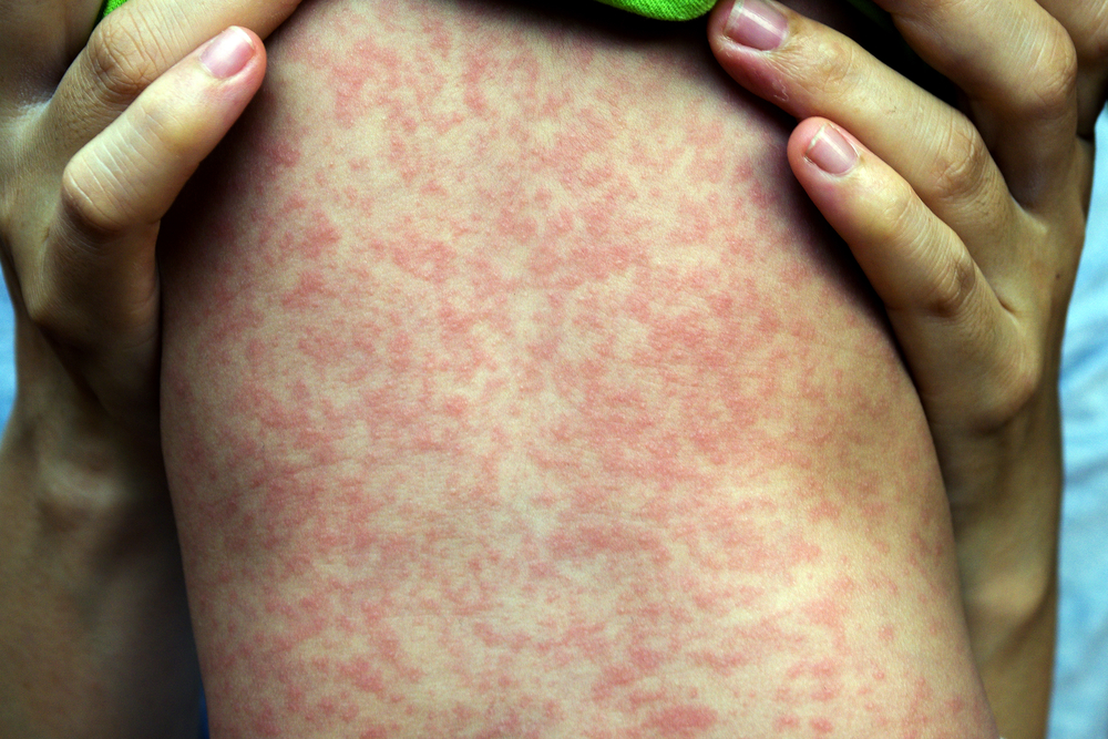 Epidemie spalniček pokračuje. Mnozí rodiče stále odmítají očkování