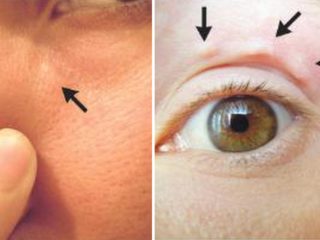 Žena si stěžovala na&nbsp;vyrážky, které jí putovaly po&nbsp;obličeji. Důvod lékaře překvapil