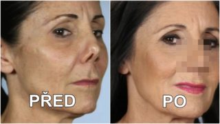 FOTO: Žena žila téměř 40 let s&nbsp;pršáčkem. Teď se konečně dočkala nového nosu!