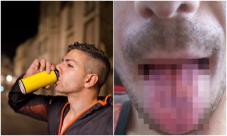 FOTO: Muž pil 6 energy drinků denně. Neuvěříte, co se mu stalo s&nbsp;jazykem!