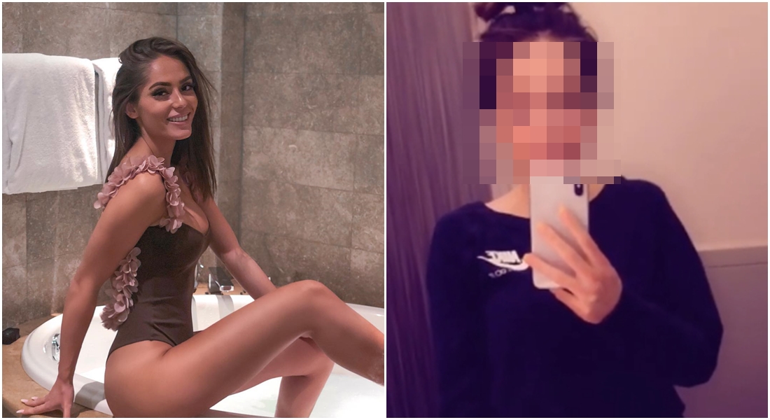Popálená youtuberka Třešničková poprvé ukázala celý obličej! Jak moc ji nehoda poznamenala?