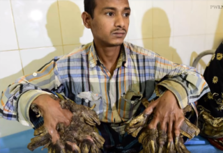 Bangladéšský “stromový muž” chce amputaci rukou, bolí ho