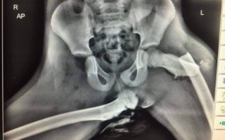 Žena měla při&nbsp;nehodě nohy na&nbsp;palubní desce. Záchranáři sdíleli děsivý rentgen