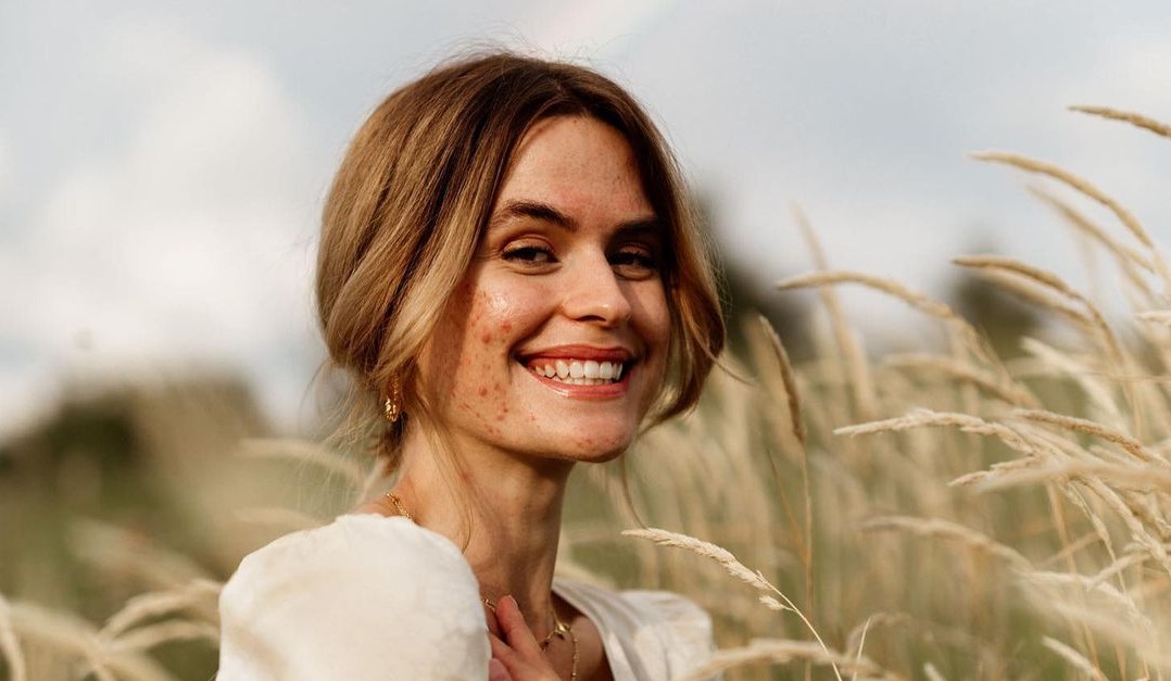 Influencerka se snaží znormalizovat akné. Nemusíte se skrývat, vzkazuje všem s&nbsp;pupínky