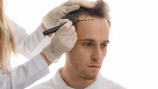 Vlasová turistika? V&nbsp;Turecku vydělají ročně miliardy díky transplantacím vlasů