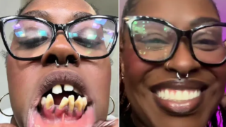 Žena netušila, že je nemocná. Nejdřív jeden viklající se zub, nakonec přišla o&nbsp;všechny