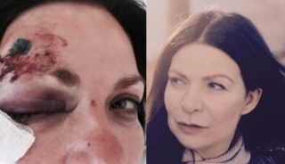 FOTO: Anna K. ukázala fotky z&nbsp;nemocnice! Takhle vypadá po&nbsp;úraze