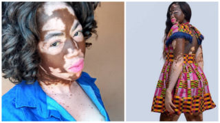 Jsi odporná a&nbsp;nakažlivá, volali na&nbsp;dívku spolužáci. Nyní je žádanou modelkou