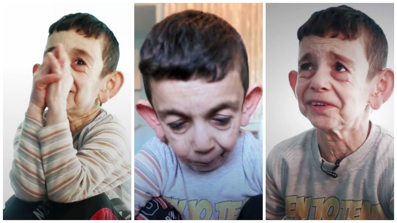 Chlapec (7) ze Sýrie vypadá jako stařec! Lidé se mi smějí, já pak pláču, líčí své trápení