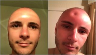 Muž si oholil hlavu a&nbsp;strávil 14 hodin na&nbsp;slunci. Netušil, co ho čeká!