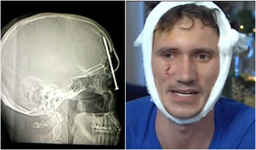 Tohle bylo o milimetry! Hřebík skončil těsně vedle dělníkova mozku FOTO