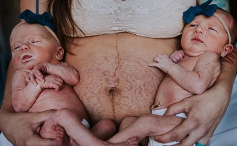Mateřství bez retuše. Maminka zveřejnila neupravenou fotku, internet jí tleská