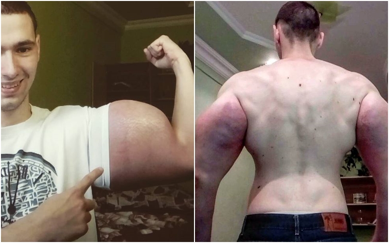 Co na to Pepek námořník? Muž (21) si vpichuje do svalů olej, riskuje vlastní život