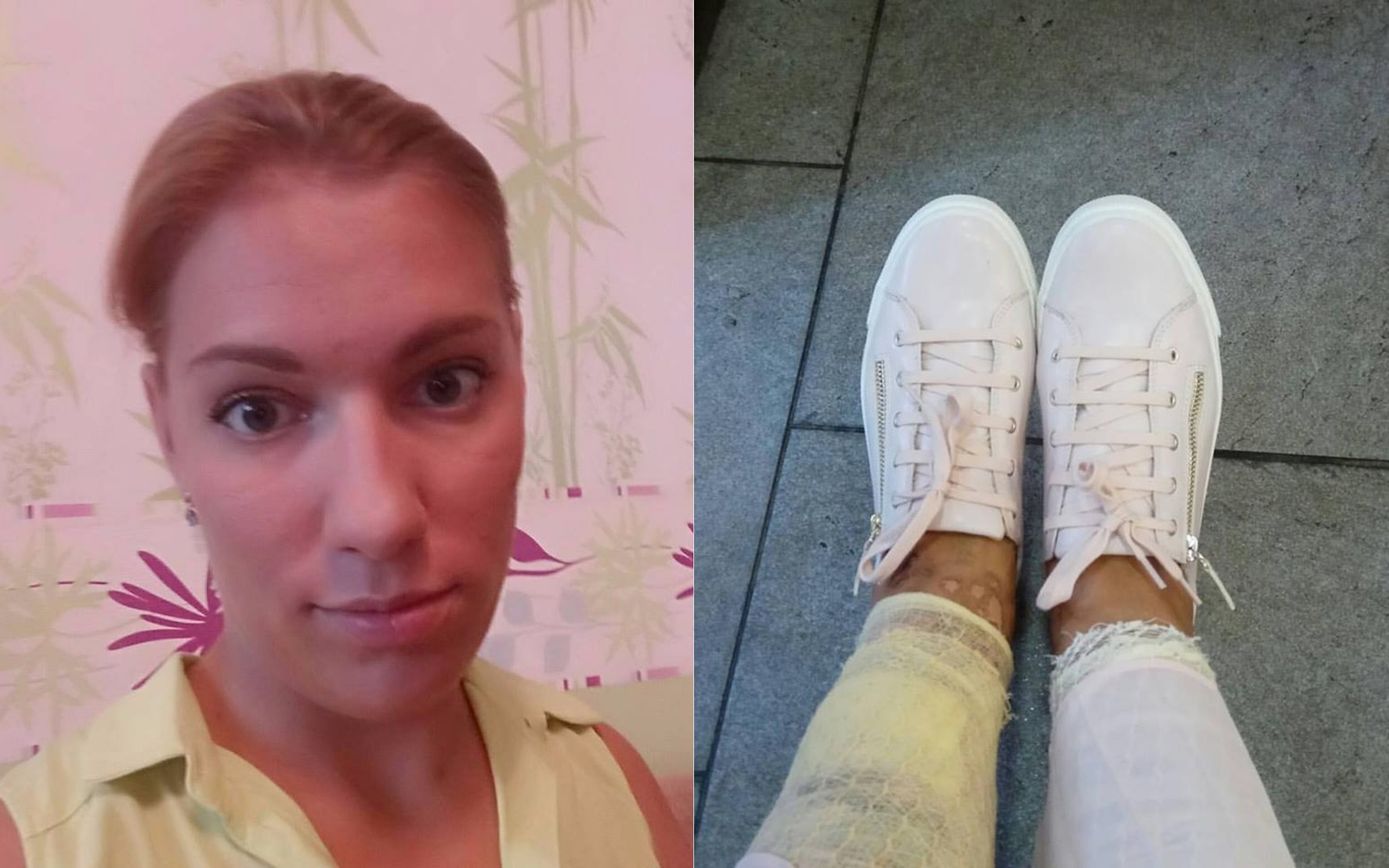 Žena podlehla kouzlu hladkých nohou s pomocí laseru. Skončila v nemocnici